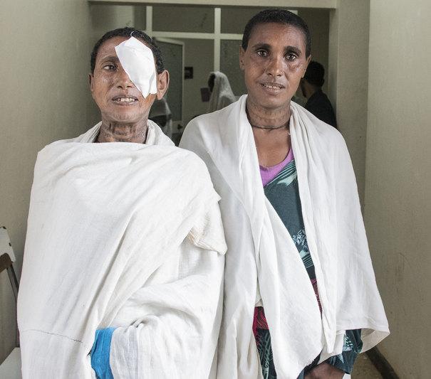 Maguaye after cataract surgery with bandage over her eye with her daughter in the hospital. Photo by Stephanie C. Glotman 