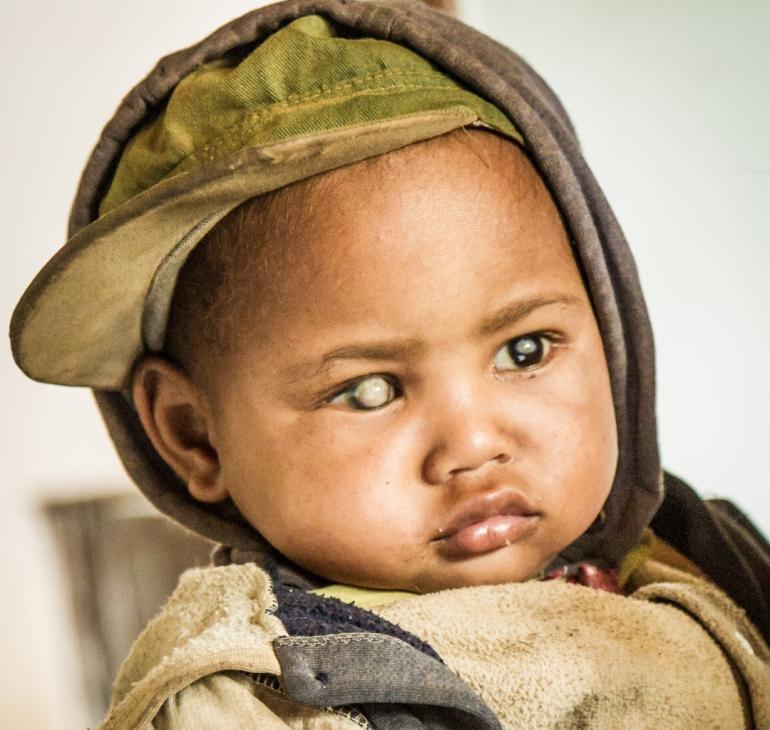 malagasy boy with visible cataract