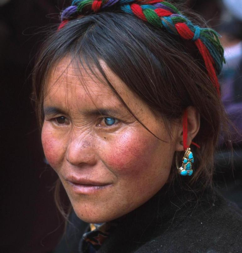 tibetan woman with visible cataracts