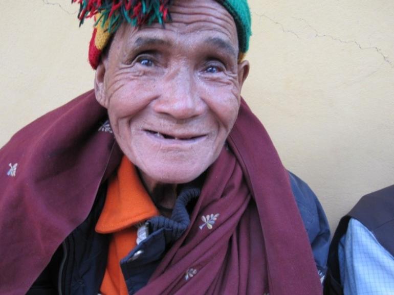 Pale Nepal Male Cataract Patient Male 2