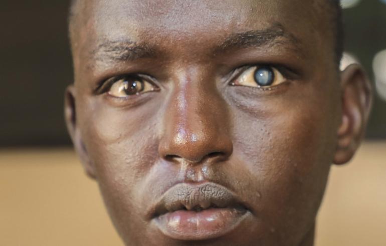 Thierry in Burundi with cataracts close up image