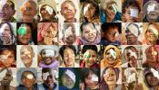 Collage of Seva patients with eye patches