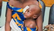 Baby Jojo in Burundi sitting in mother's lap with eye bandage by Jean de Dieu