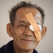 Cambodian man smiling after cataract surgery wearing eye patch