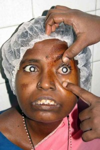 Photo of Indian woman blind from mature bilateral cataracts